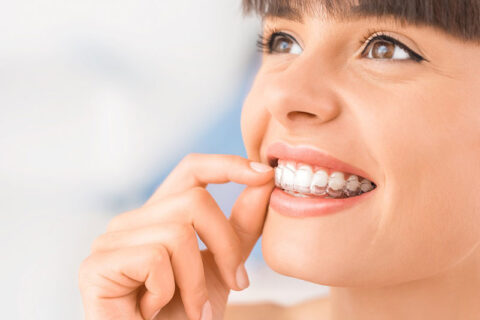 a woman applying aligners on the teeth