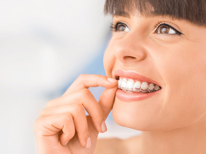 a woman applying aligners on the teeth
