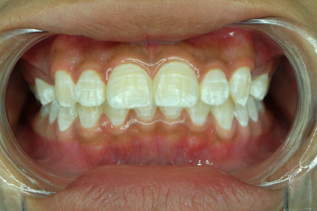 White Spots on the teeth
